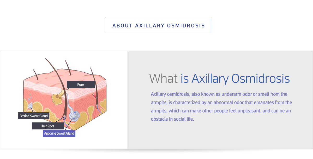 About Axillary Osmidrosis